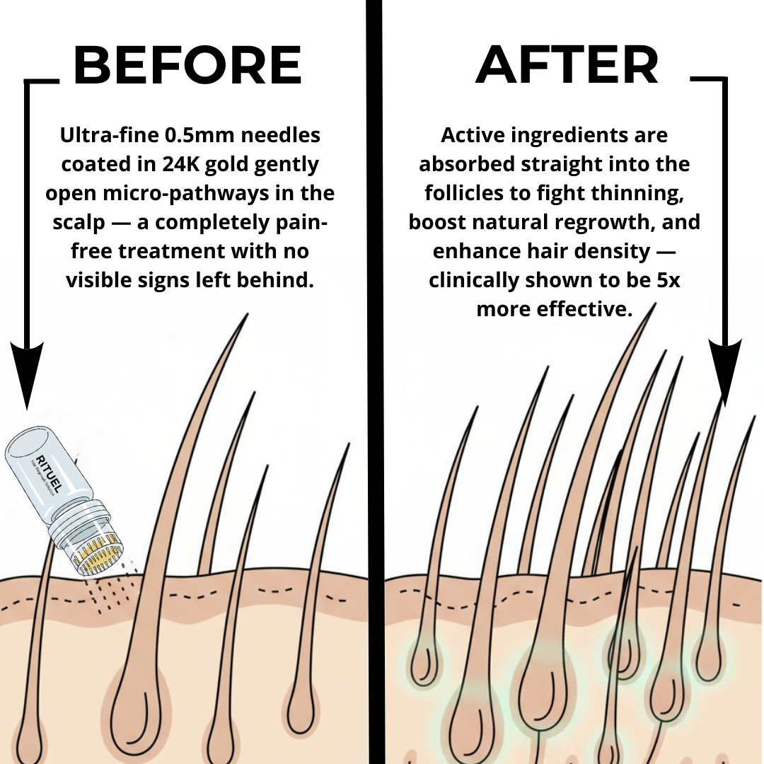 RITUEL™ Hair Regrowth System