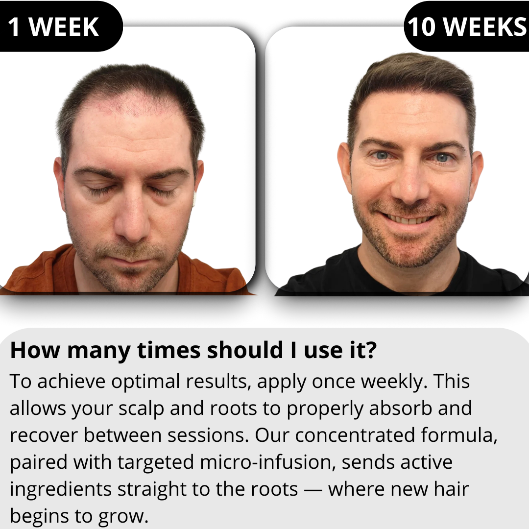 RITUEL™ Hair Regrowth System
