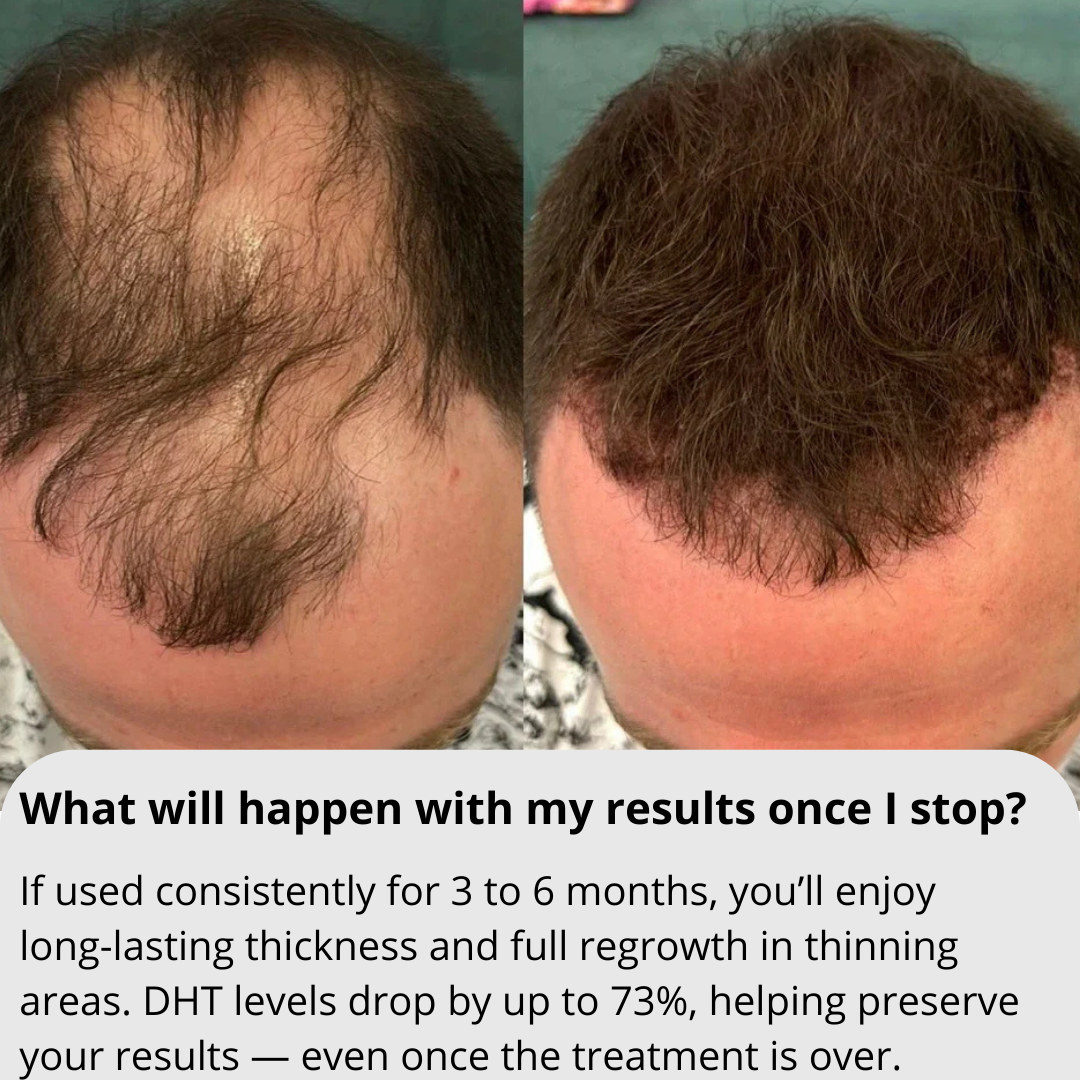 RITUEL™ Hair Regrowth System