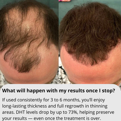 RITUEL™ Hair Regrowth System